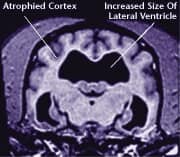 Damaged brain