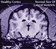Healthy brain